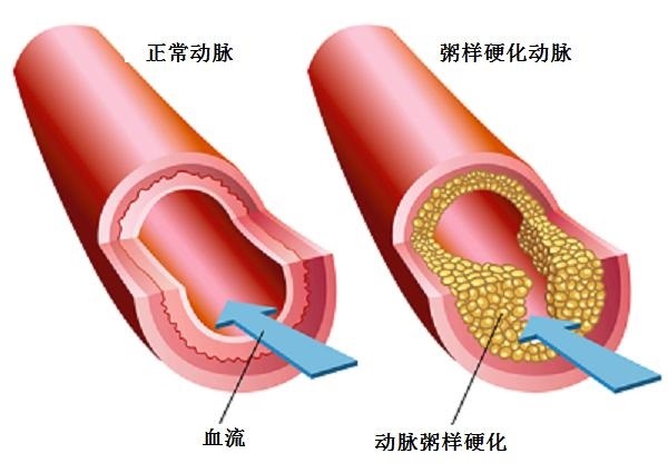 動脈硬化大百科:動脈粥樣硬化的發生機制 動脈硬化大百科:動脈粥樣硬化的發生機制